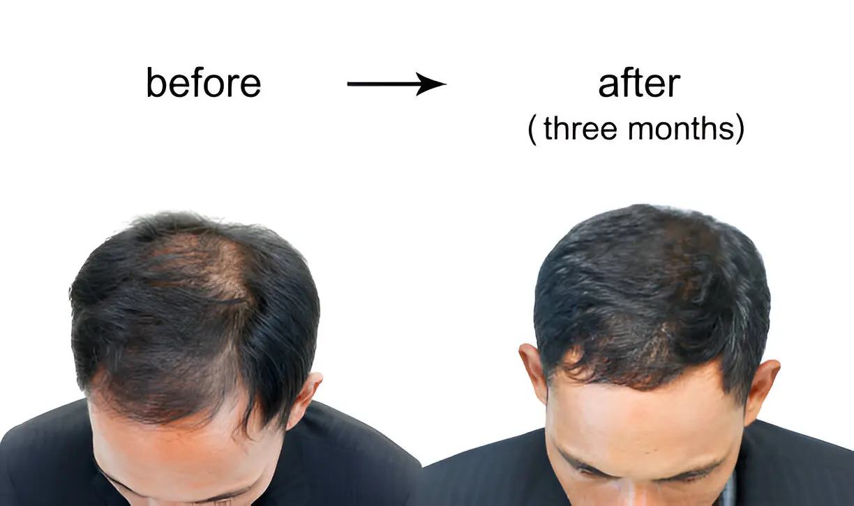 Exploring the Advantages of DHI Hair Transplant for Seamless Hair Restoration