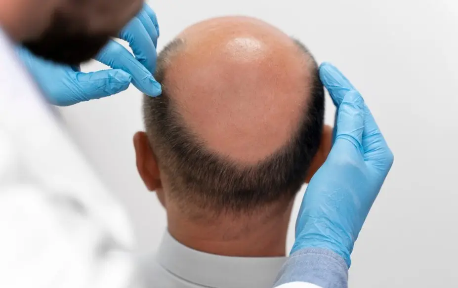 Why Select A Manual FUE Hair Transplant Over Automated Methods